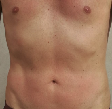 Dopo il trattamento estetico