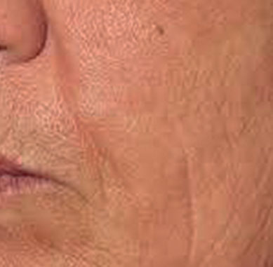 Dopo il trattamento estetico