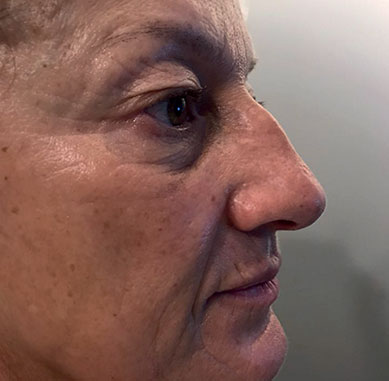 Dopo il trattamento estetico