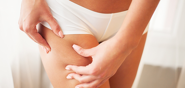 Cellulite Edematosa: cause e rimedi per combatterla | Selenia Italia
